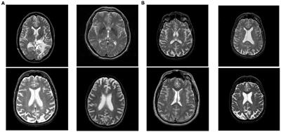 DSNN: A DenseNet-Based SNN for Explainable Brain Disease Classification